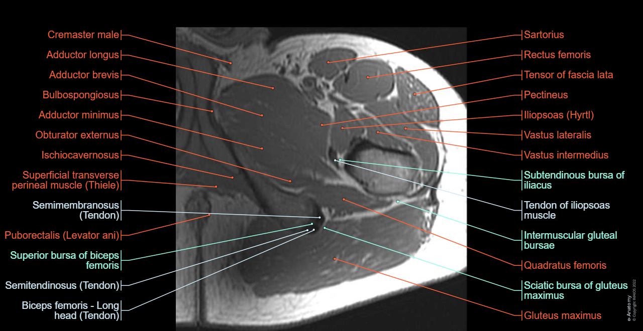 The hip anatomy on 3T MR and 3D pictures: Adductor longus, Quadriceps femori
