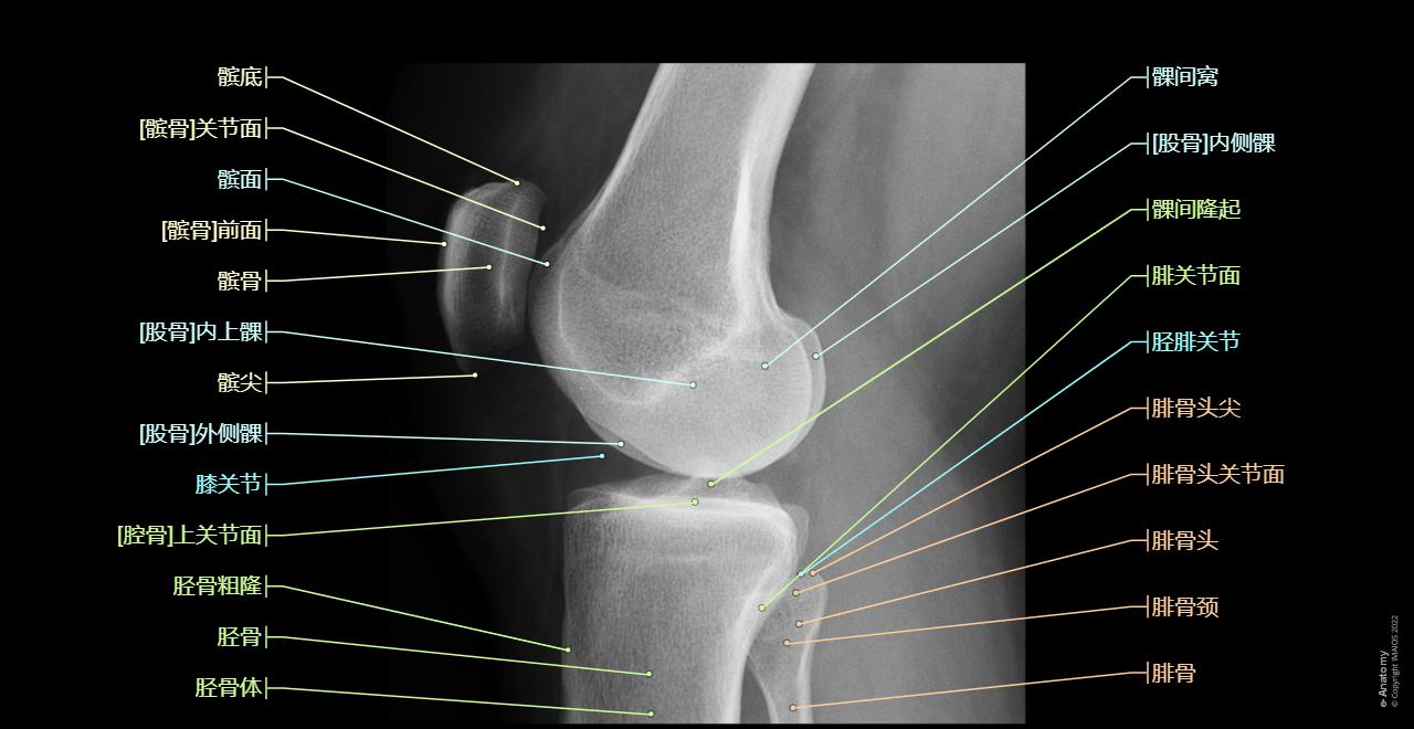 Knee joint - Radiographs (Lateral view) :Patella, Medial condyle, Lateral condyle