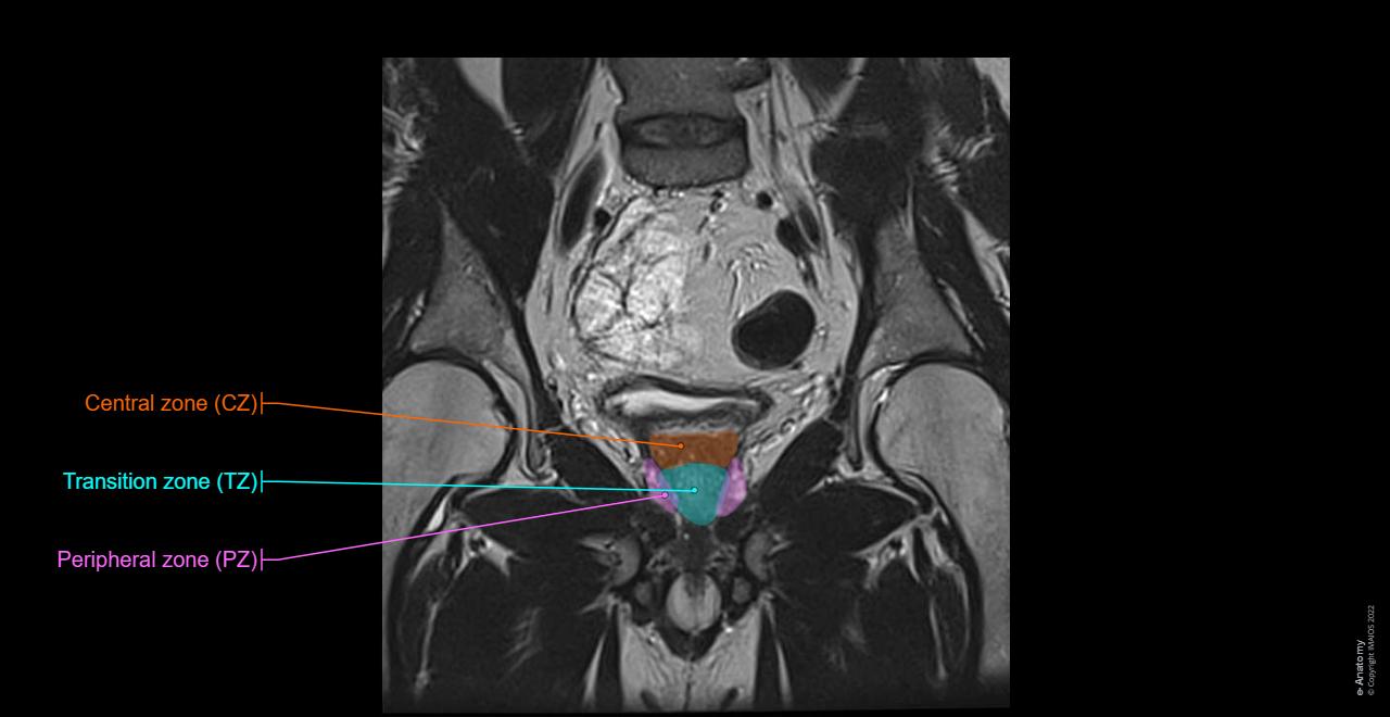 Zonal anatomy of prostate (McNeal)-MRI: Peripheral zone (PZ), Central zone (CZ), Transition zone (TZ), Anterior Fibromuscular Stroma (AFMS), Neurovascular bundle (NVB)