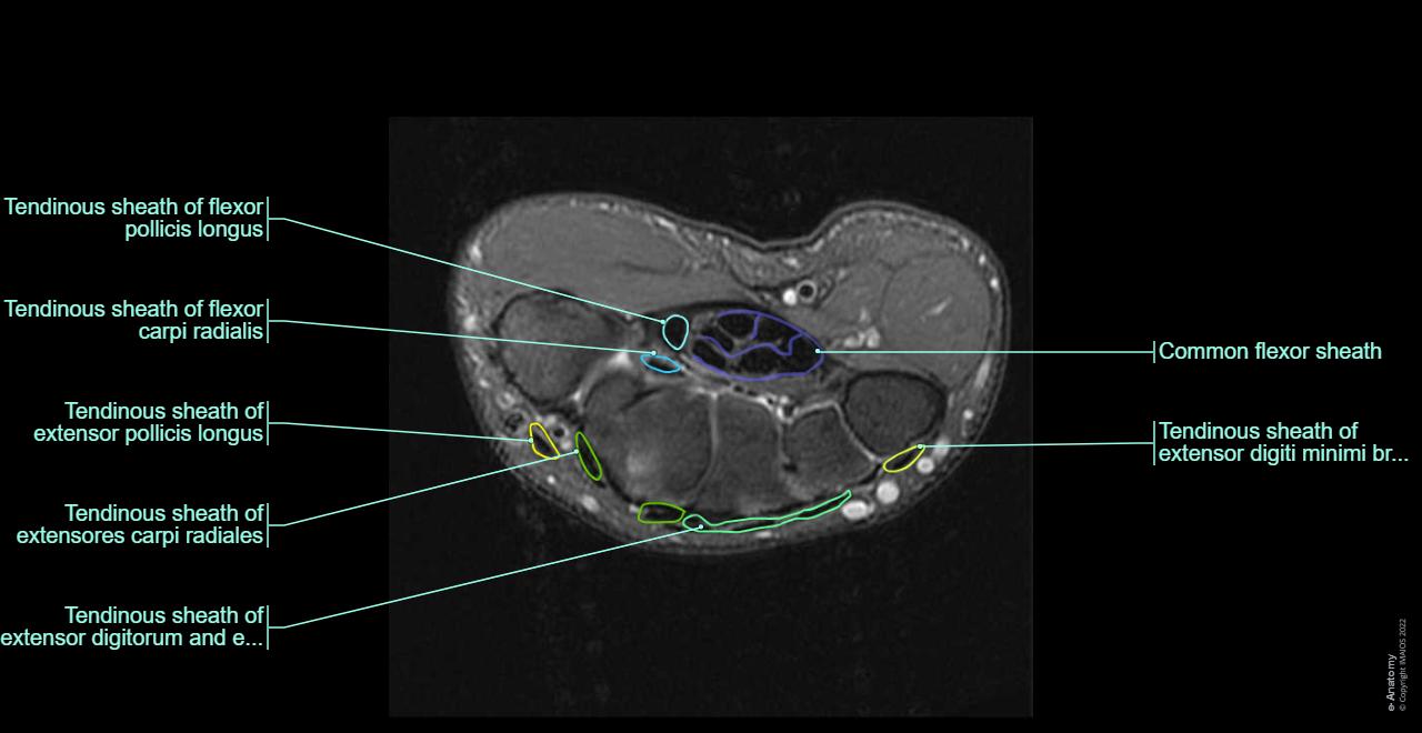 The wrist anatomy on 3T MR and 3D pictures : Tendons, Carpal tendinous sheaths