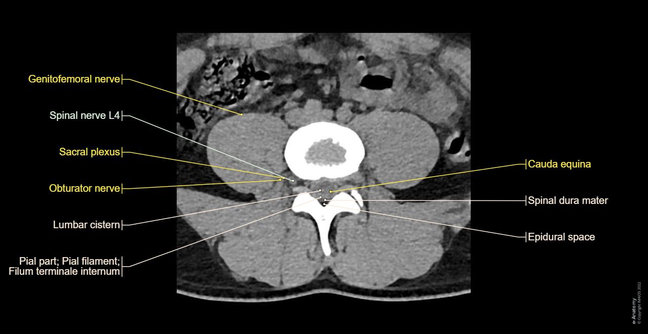 CT scan of lumbar spine