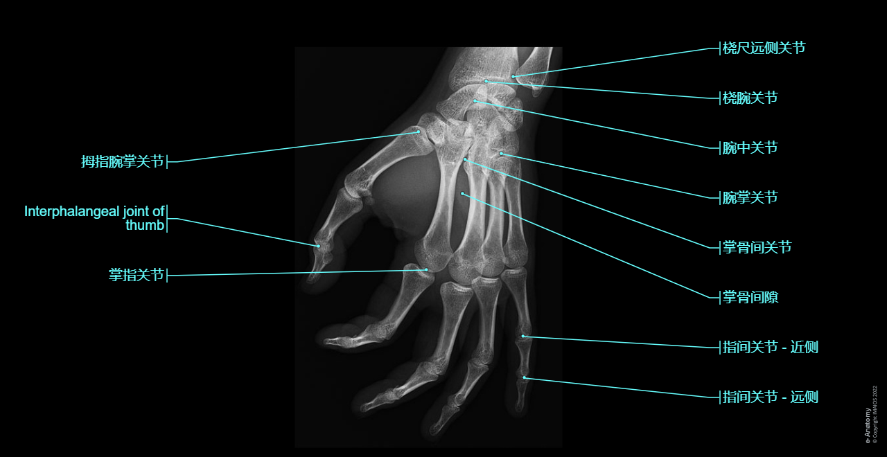 Radiographs - Hand - Digiti manus : Metacarpals [I -V],  Digital bones; Phalanges,  Proximal phalanx,  Middle phalanx,  Distal phalanx,  Sesamoid bones, Carpometacarpal joints,  Intermetacarpal joints,  Metacarpophalangeal joints,  Interphalangeal joints of hand