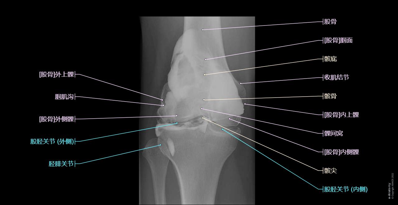 Knee joint: Arthrogram (Arthrogram)