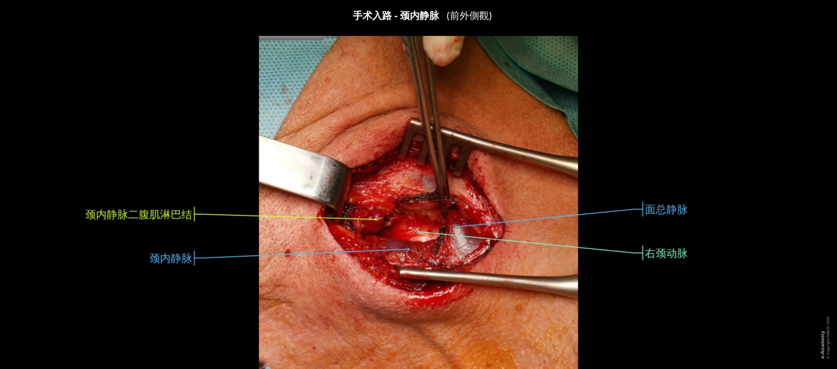 人颈动脉手术入路照片：颈内静脉