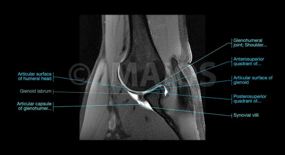 Shoulder MR arthrogram in the ABER position-T1 FS: the glenohumeral joint, the shoulder joint, the supraspinatus tendon, the glenoid labrum can be distinguished