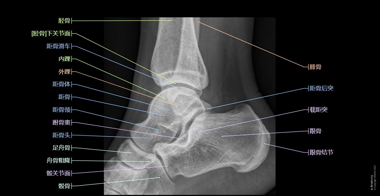 Talus - Calcaneus (-Lateral view) :Neck of talus, Sustentaculum tali; Talar shelf, Tarsal sinus, Fibular trochlea; Peroneal trochlea; Peroneal tubercle