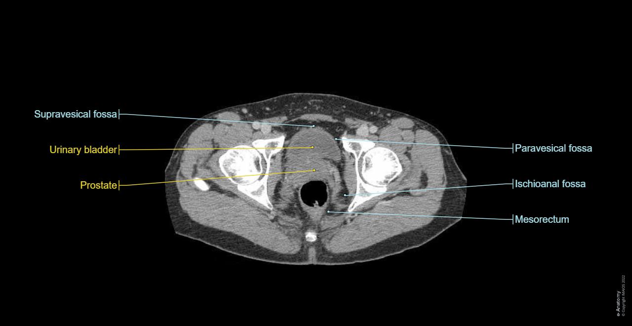 Anatomy of the human body : axial slice of the male pelvis with prostate, urinary bladder, muscles, bones and fossa.