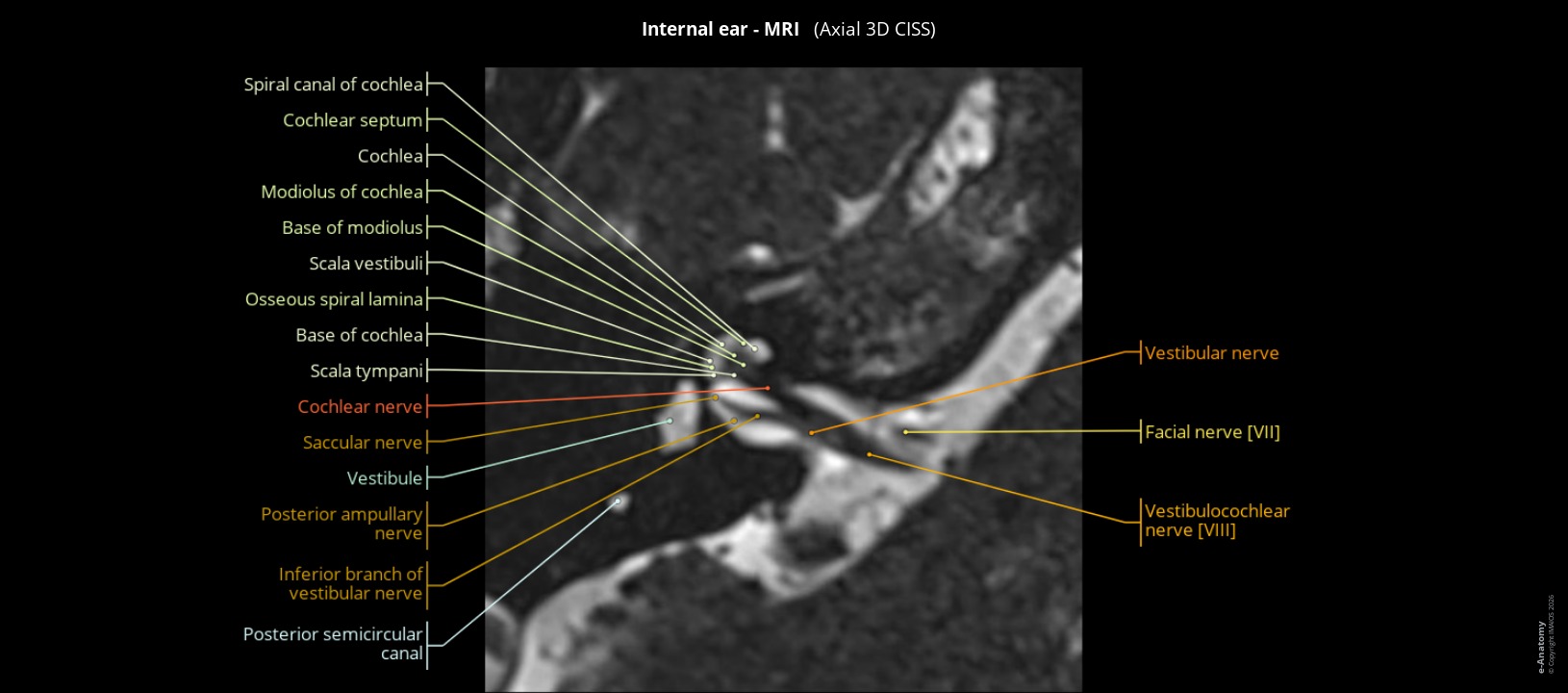 MRI of the human inner ear: axial 3D CISS section