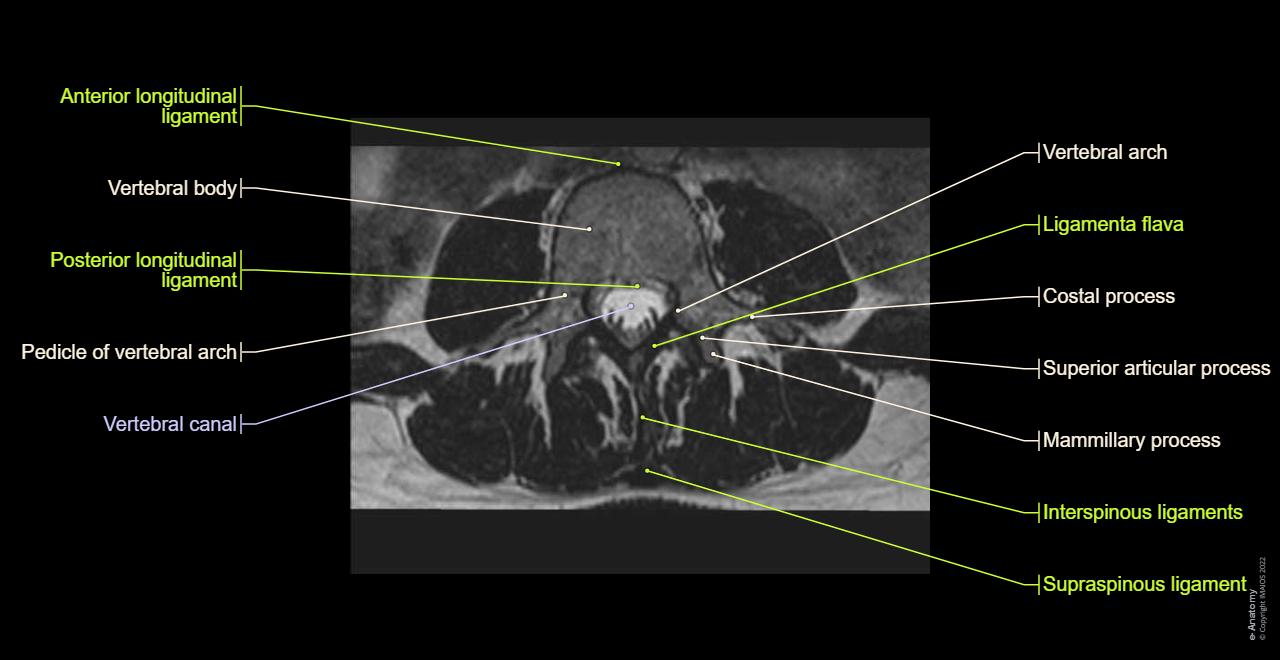 Anatomy of the lumbar vertebrae (cross-sectional imaging on T1, T2 and 3D MR): Zygapophysial joints, Vertebral body, Pedicle of vertebral arch, Ligamenta flava