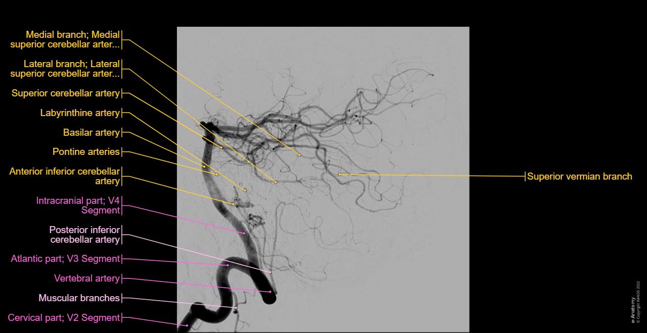 Vertebral artery - Basilar artery:Cerebral angiography - Lateral view