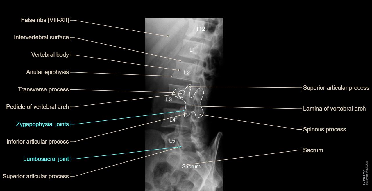 Vertebral column - Anterior oblique view : "Scotty dog" : Pedicle of vertebral arch, Zygapophysial joints, Lamina of vertebral arch, Superior articular process, Inferior articular process, Intervertebral surface