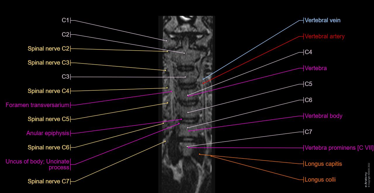 Anatomy of the cervical spine (MRI) , Coronal T2