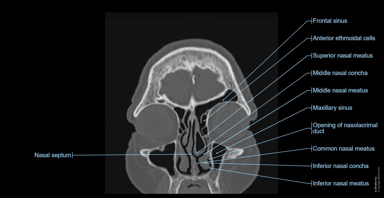 Paranasal sinuses, CT, Frontal sinus, Maxillary sinus, Ethmoidal cells