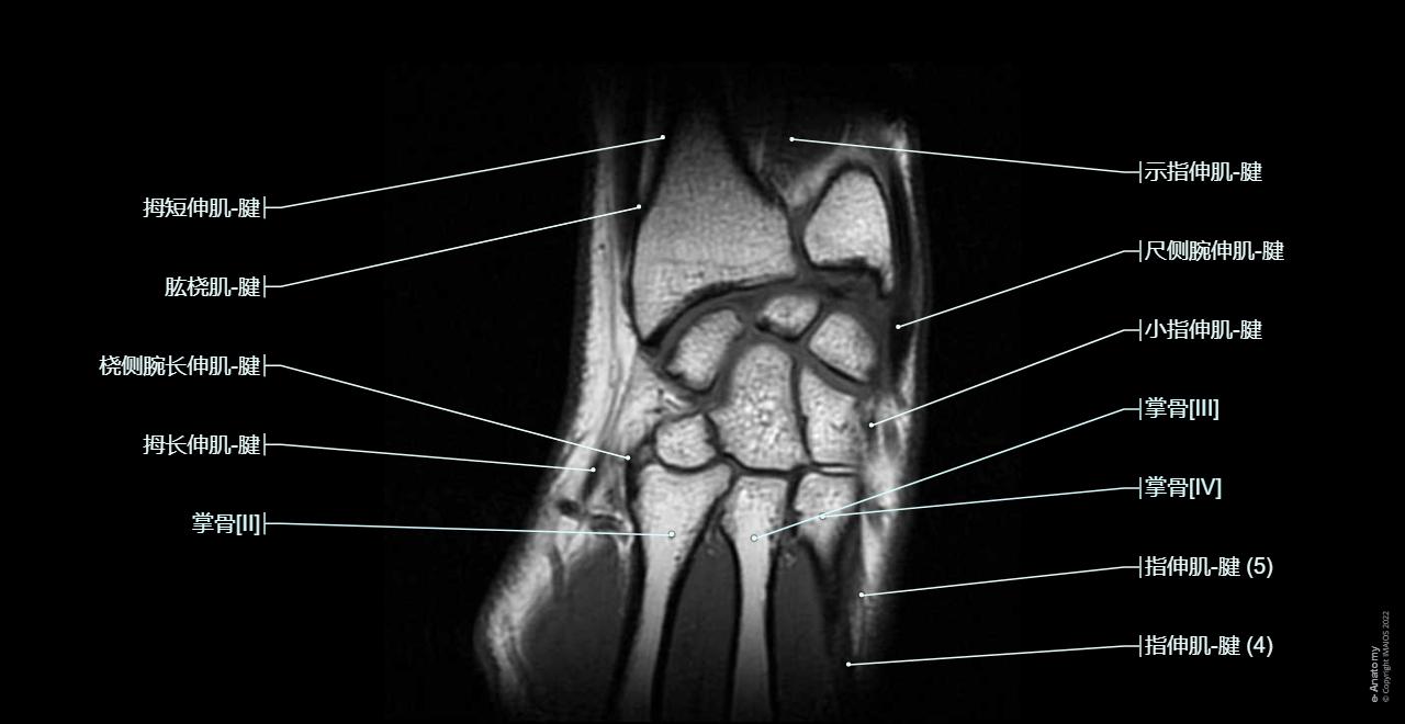 Wrist joint - MRI: Dorsal radiocarpal ligament, Palmar ulnocarpal ligament, Carpal joints; Intercarpal joints, Radiate carpal ligament