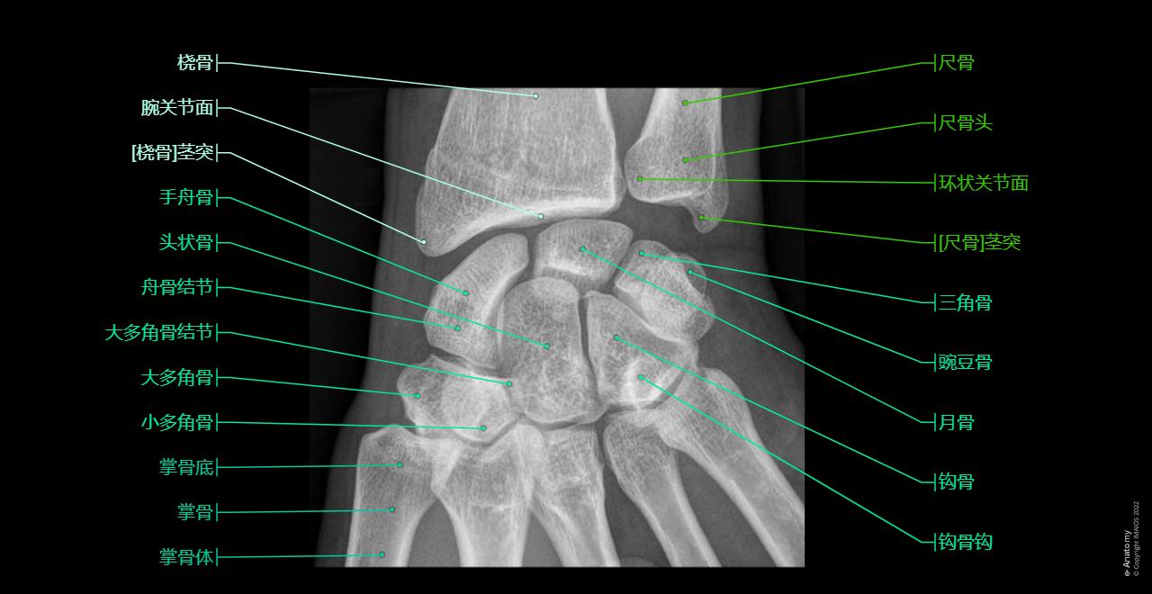 Anatomy atlas - Radiographs - Wrist : Scaphoid, Tubercle, Lunate, Triquetrum, Pisiform, Trapezium, Tubercle, Trapezoid, Capitate, Hamate, Distal radioulnar joint, Wrist joint, Carpal joints; Intercarpal joints, Midcarpal joint, Pisiform joint, Carpometacarpal joints