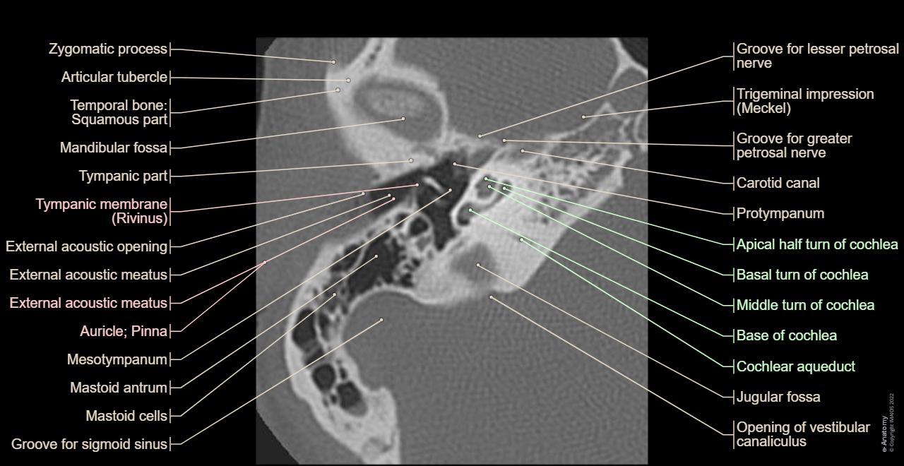 Interactive atlas of the temporal bone and ear : axial slice with all structures labeled