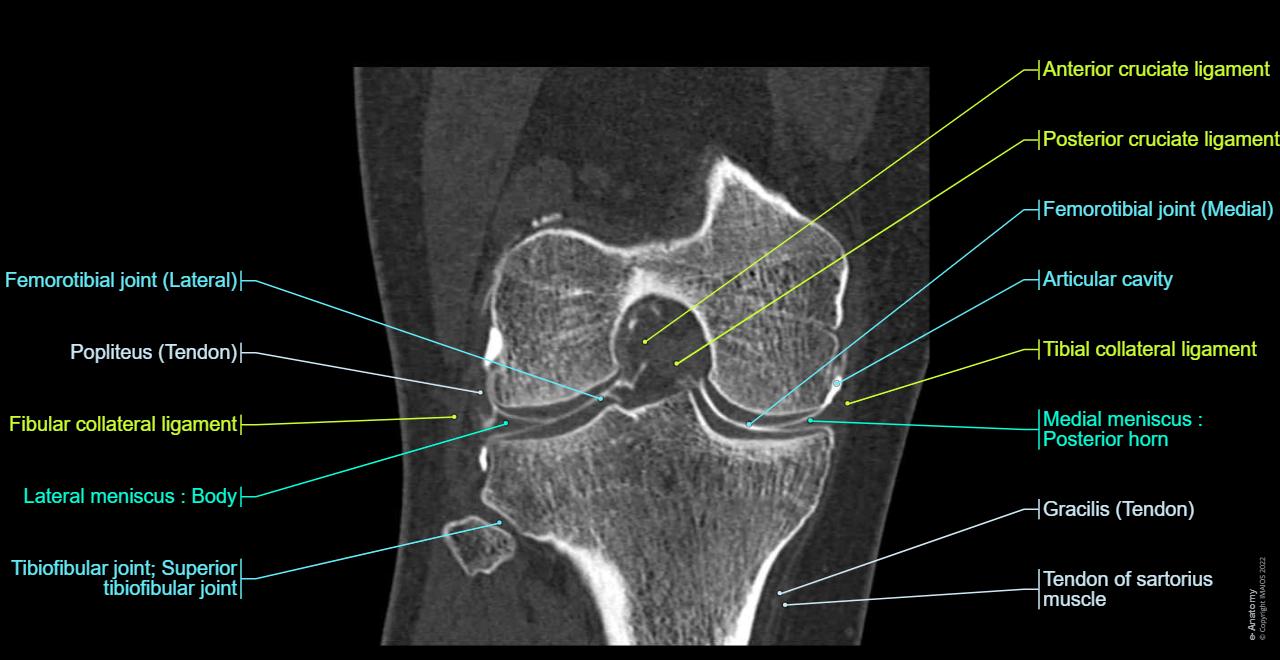 Knee joint - CT arthrogram: Knee joint, Lateral meniscus, Fibular collateral ligament, Tibial collateral ligament
