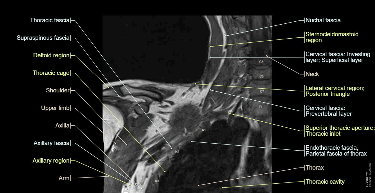 Brachial plexus : Anatomy (MRI Coronal section), Cervical plexus