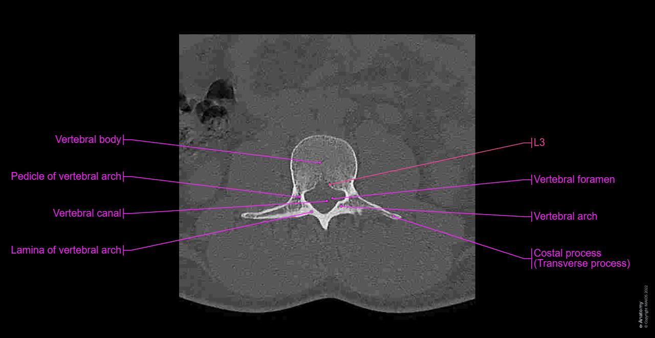 CT scan of lumbar spine