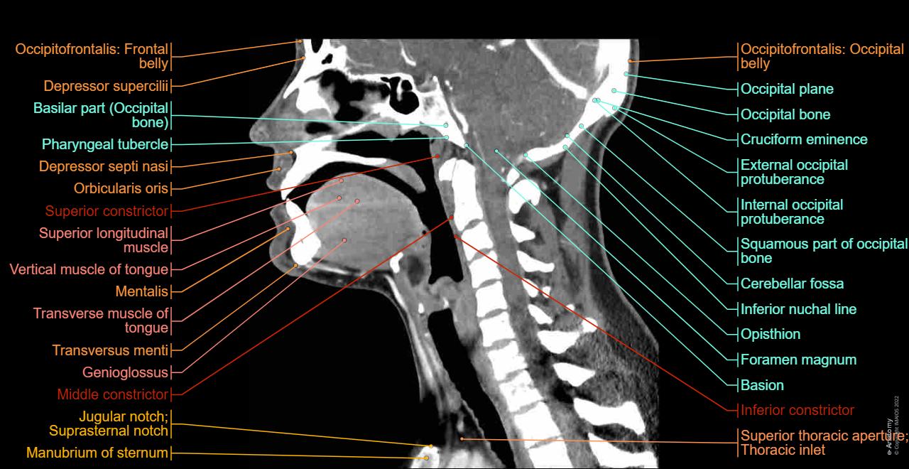 CT scan of head and neck