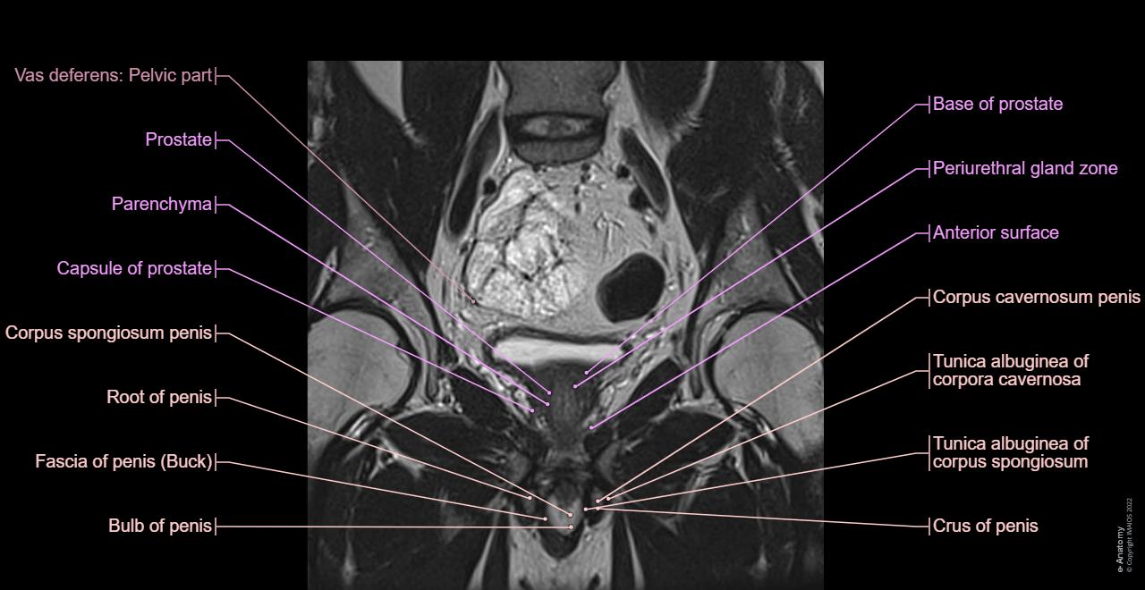 Male pelvis - MRI - Coronal section: Levator ani, Perineum, Pelvic cavity