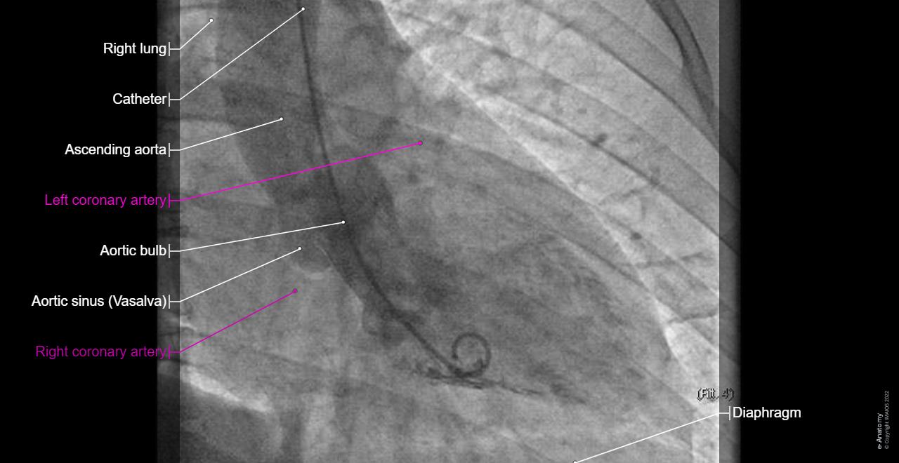 Ventriculography : Left ventricle, Aorta