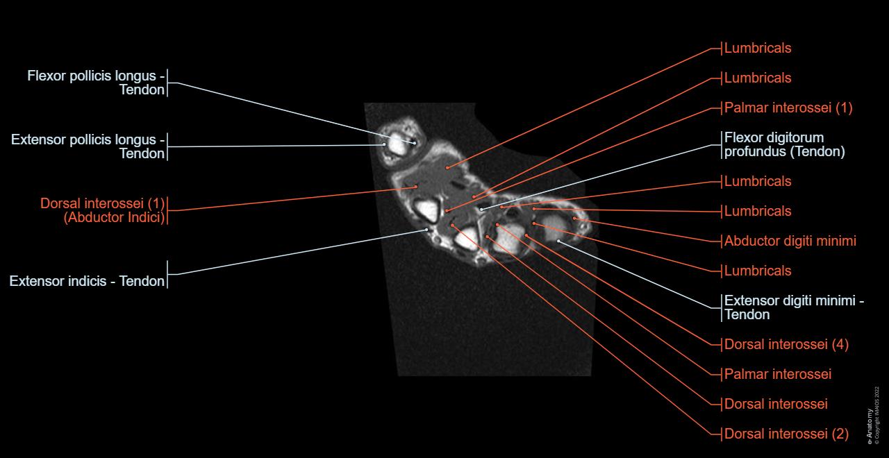 Anatomy of the hand : axial slice of MRI (Magnetic Resonance Imaging) wtith anatomical structures labeled.