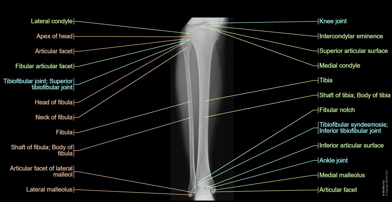 Leg - Radiograph: Tibia, Fibula