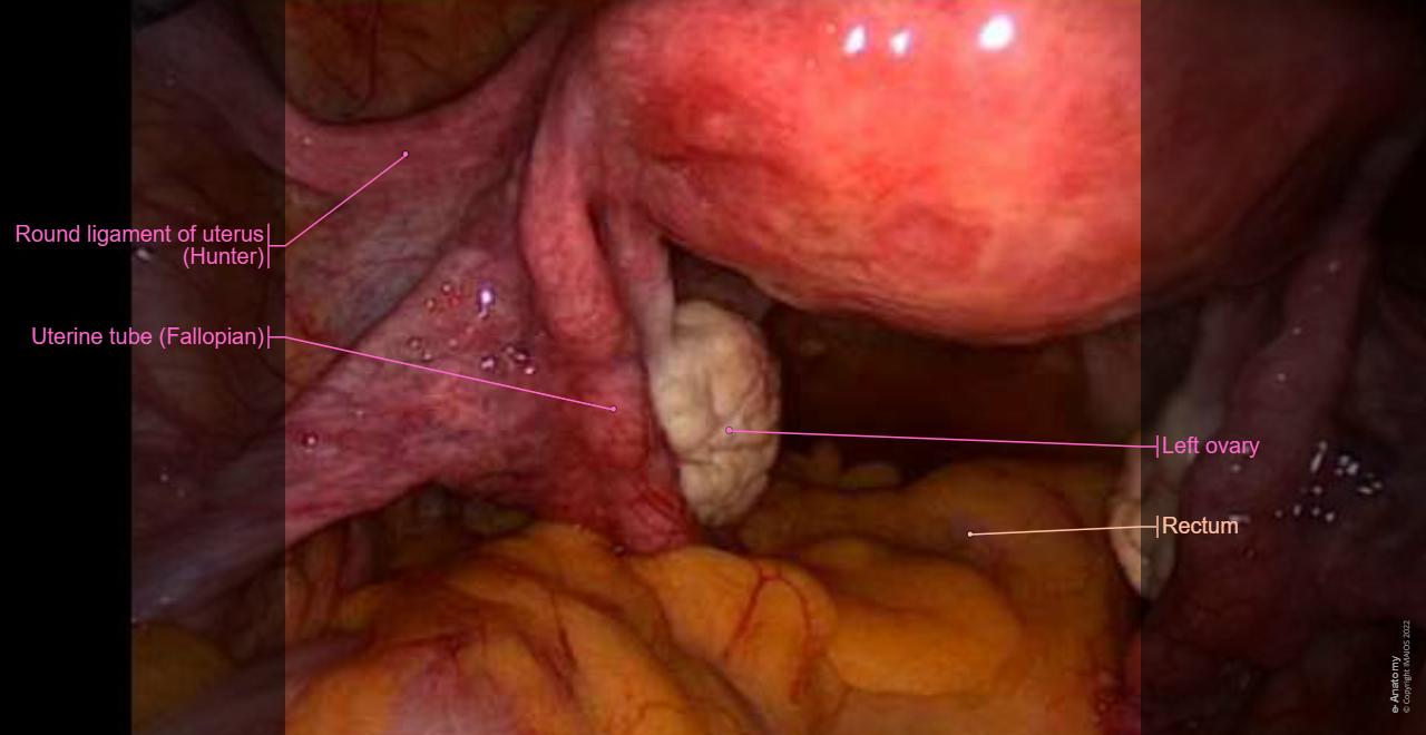 Female pelvis: Uterus, Ovary, Rectouterine pouch female