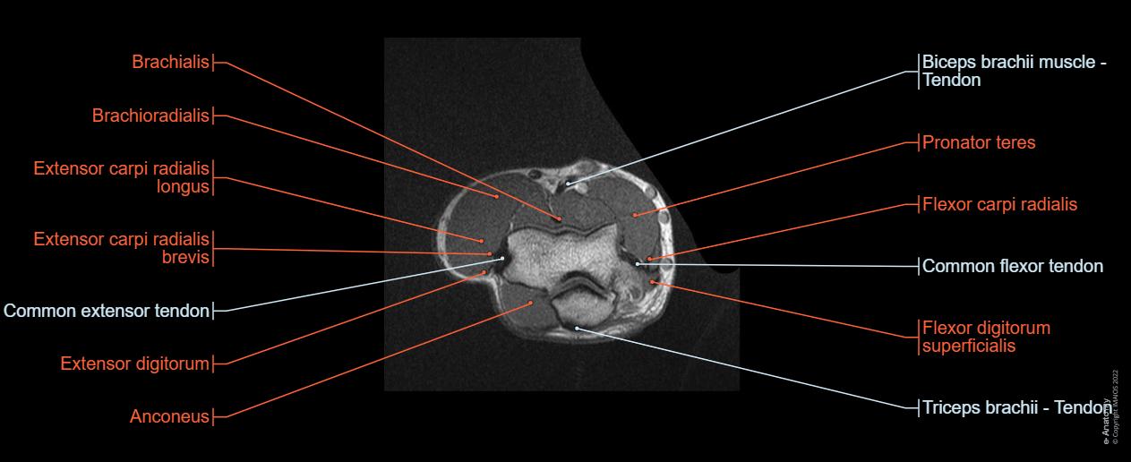 Human anatomy of the bend : bones (capitulum, trochlea, medial and lateral epicondyle, olecranon), common extensor and flexor tendon, nerves (radial, median , ulnar), cephalic and basilic veins...
