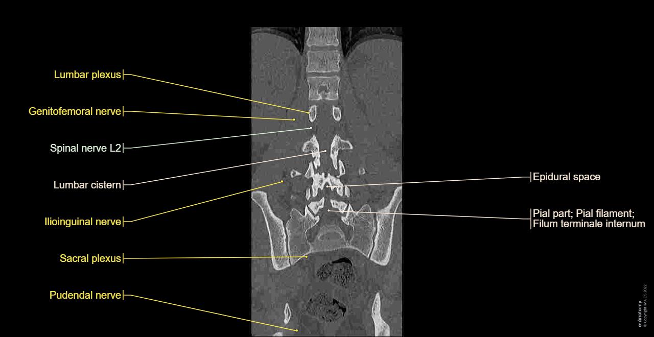 CT scan of lumbar spine