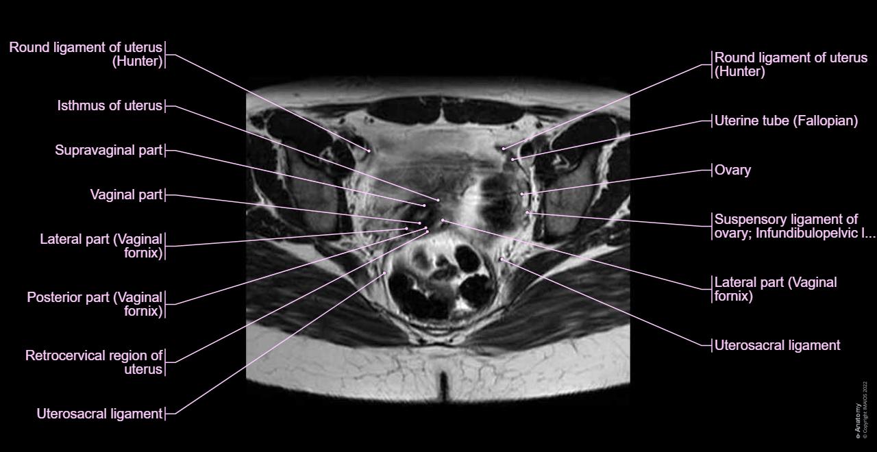 Anatomy of the female pelvis : axial slice showing uterus, ovary, uterine tubes, ligament, vaginal cavity and other internal organs.