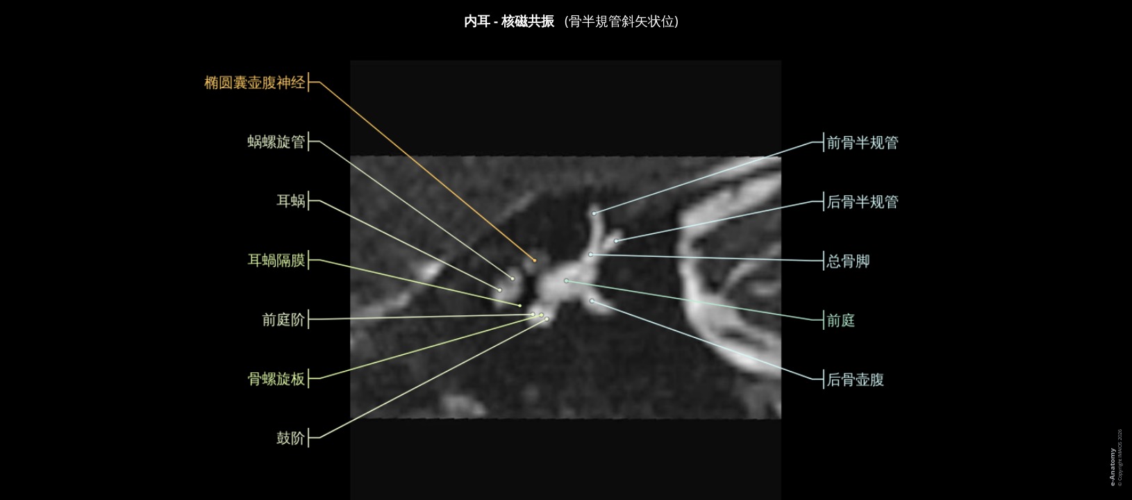 人类内耳磁共振成像：经上半规管的斜矢状切面