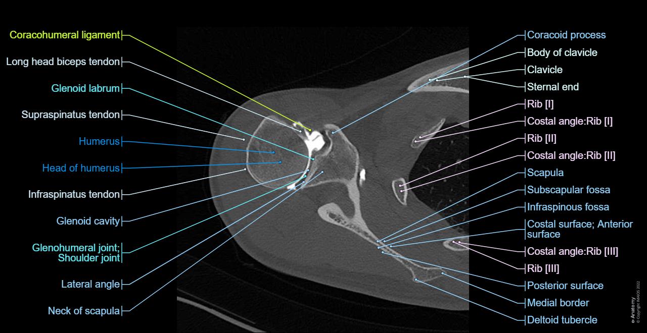 CT arthrogram of the shoulder joint : Glenoid labrum, Glenohumeral ligaments