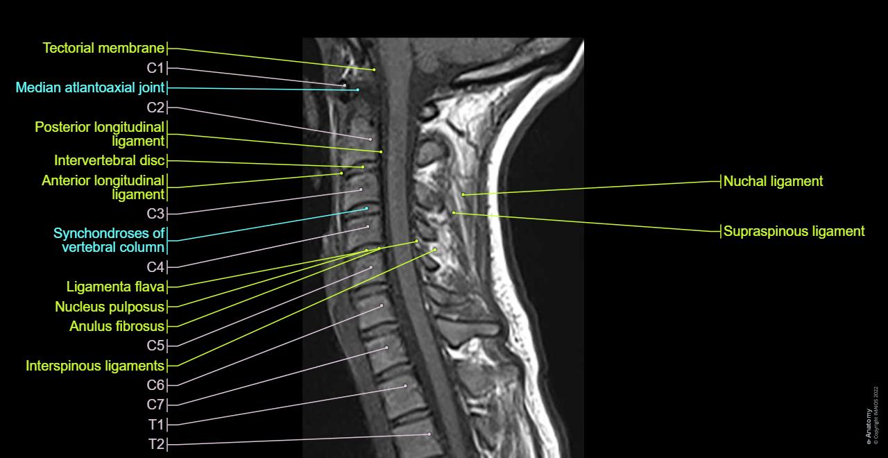 MRI of cervical spine