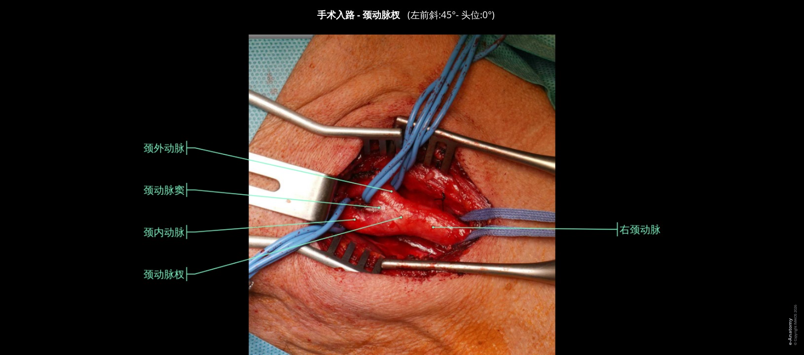 颈动脉区域解剖图谱：人体手术入路