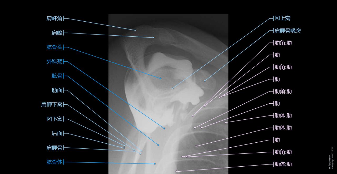 CT arthrogram of the shoulder joint : Acromion, Coracoid process