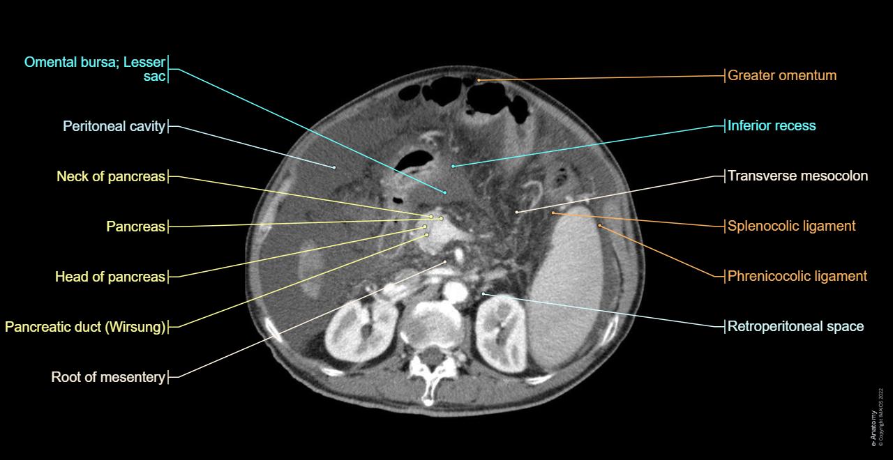 Anatomy of the abdominopelvic cavity (CT-Scan):Omental bursa; Lesser sac, Omental foramen; Epiploic foramen, Paracolic gutters, Subhepatic space