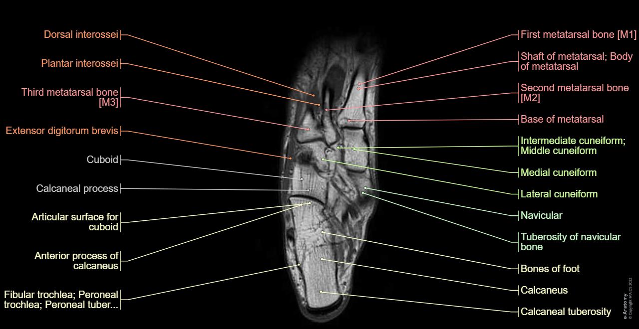 Cross section of the foot with anatomical structures labeled as arteries, muscles (dorsal interossei, plantar interossei, lombrical, extensor digitorum brevus), nerves, ligament, bones...