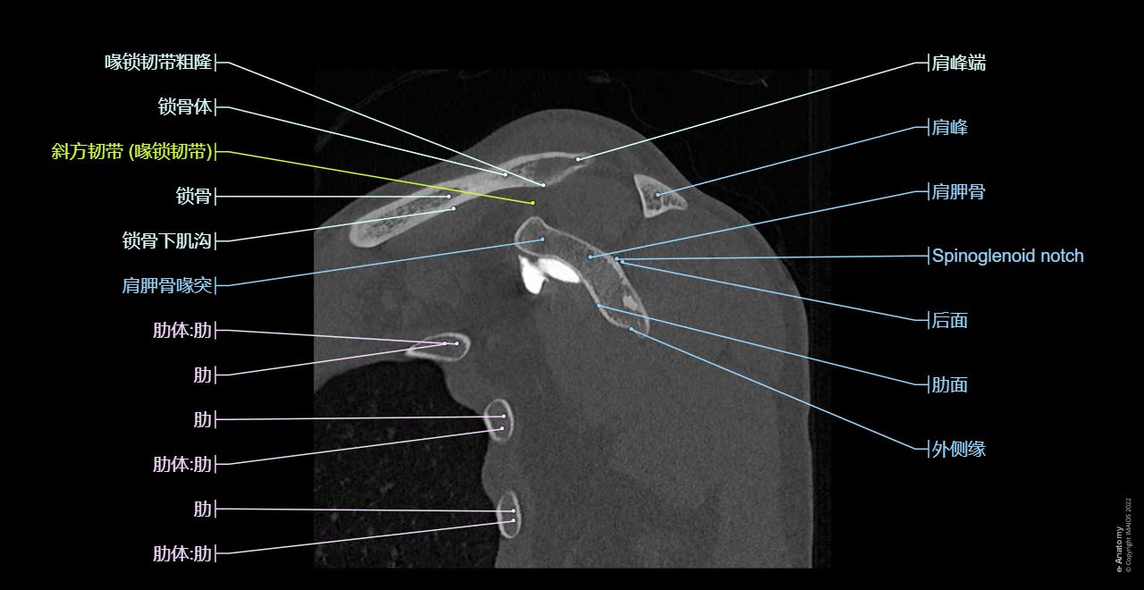 CT arthrogram of the shoulder joint : Glenohumeral ligaments, Scapula