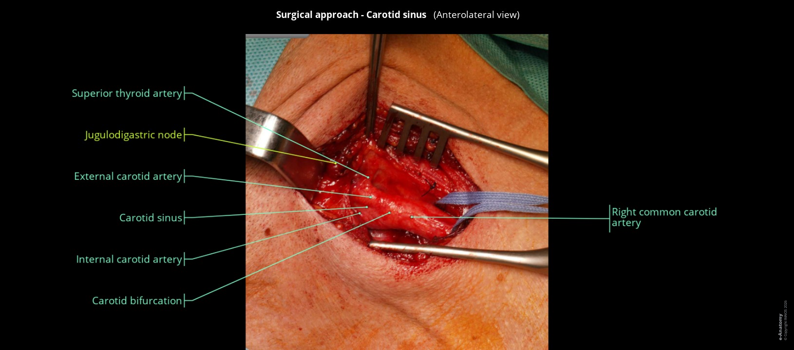 Labeled image of carotid artery surgery in humans