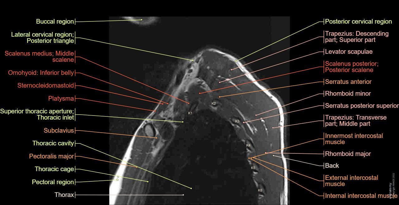 Superior thoracic aperture; Thoracic inlet: Anatomy, MRI Sagittal section, Subclavian artery, Subclavian vein, Scalenus anterior; Anterior scalene