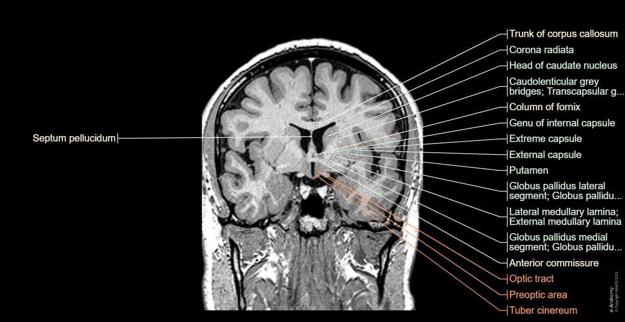 Brain - Coronal section:Basal nuclei and related structures, Corpus callosum, Septum pellucidum