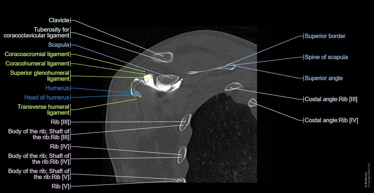 CT arthrogram of the shoulder joint: normal anatomy | e-Anatomy