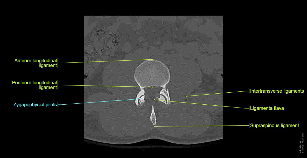 CT scan of lumbar spine