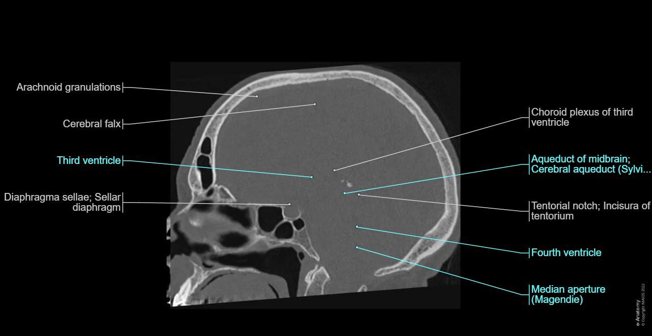 Bones of cranium - Anatomy - CT: Sphenoid bone, Occipital bone, Clivus, Foramen magnum