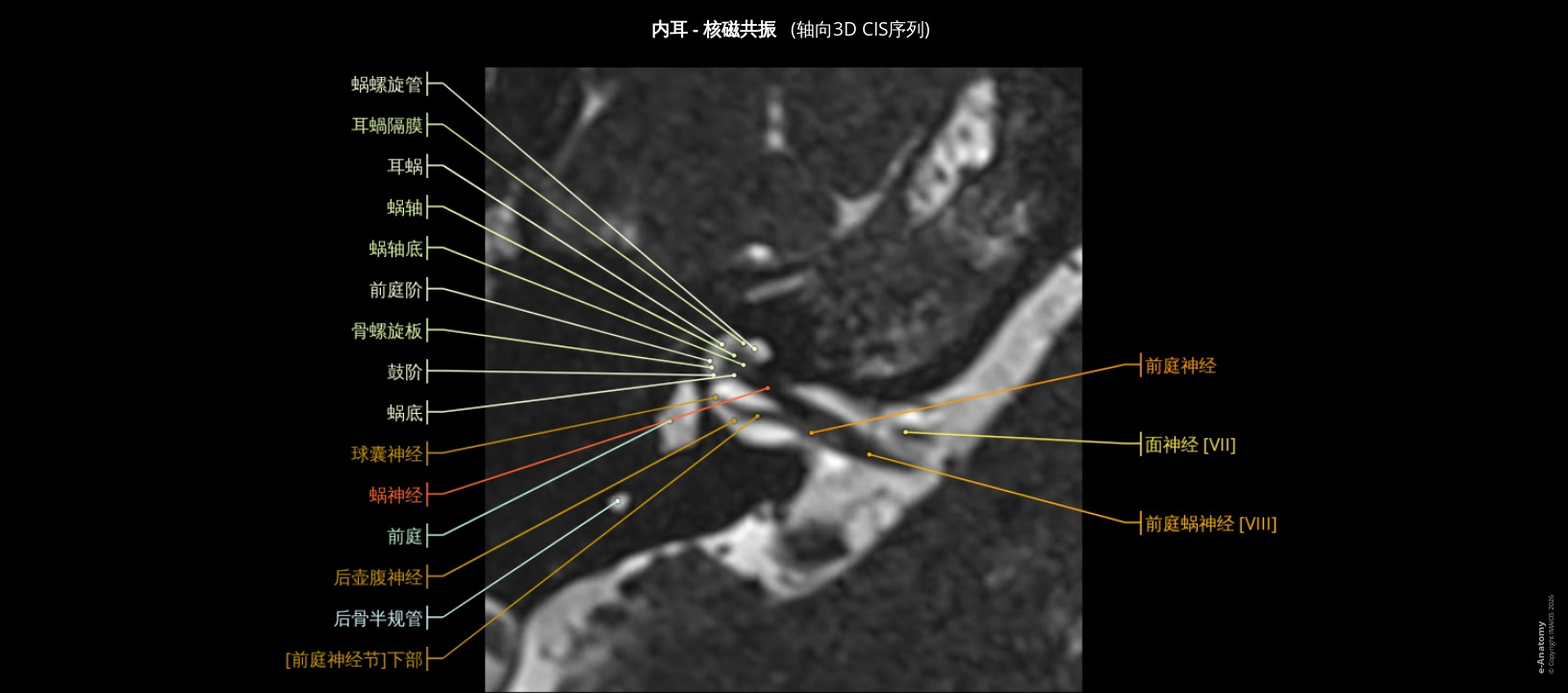 人内耳MRI成像：轴位3D CISS切面