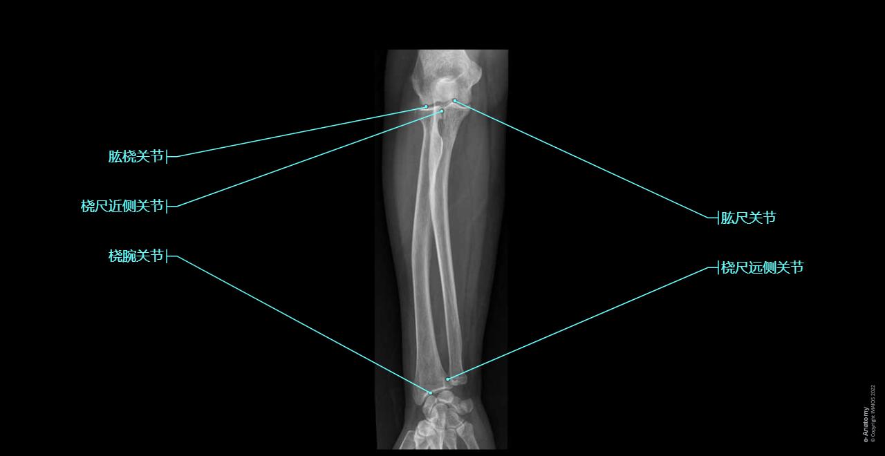 Radiographs - Forearm : Radius, Ulna, Capitulum of humerus, Tuberosity of ulna, Radial tuberosity, Pronator tuberosity, Interosseous border