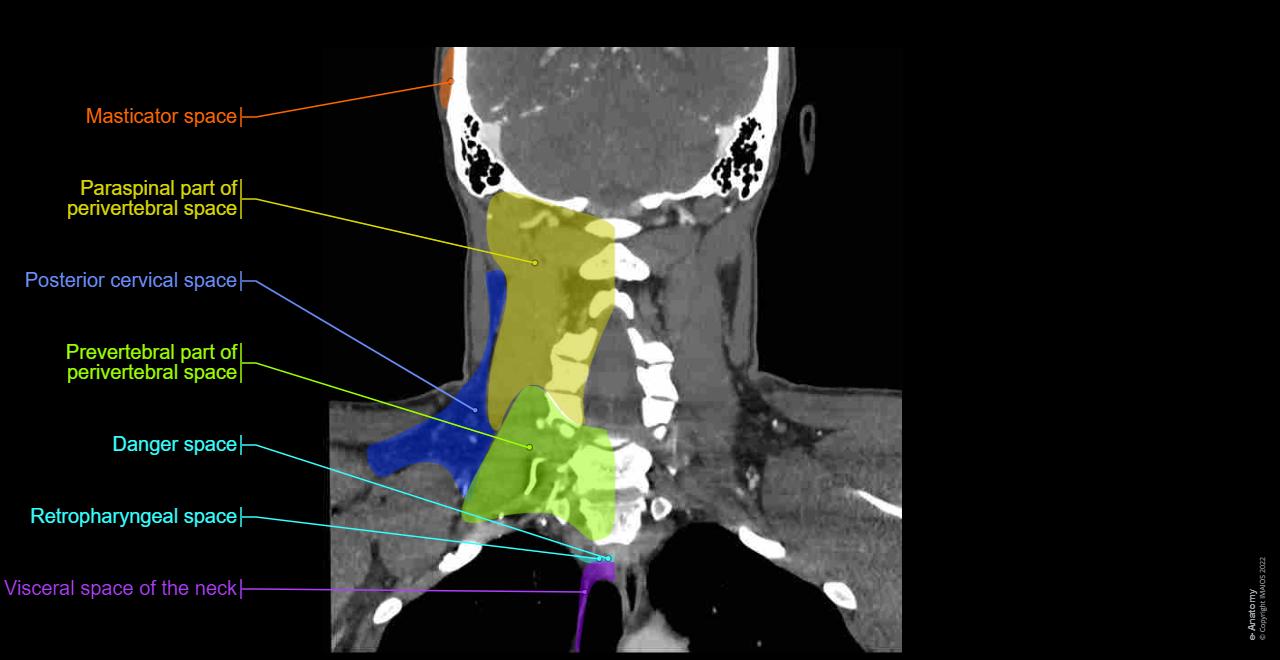 CT scan of head and neck