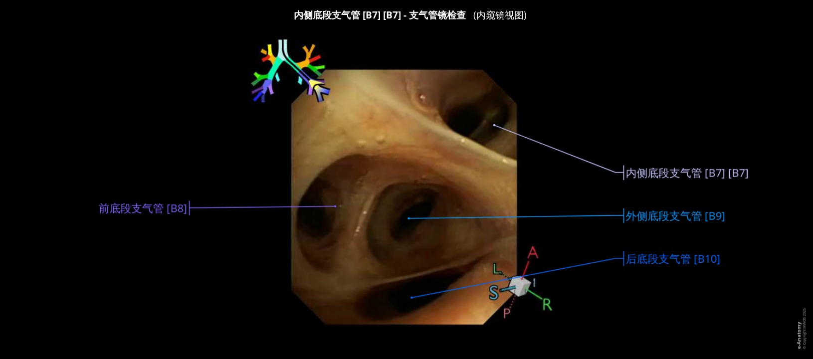 患者支气管树内镜标注图